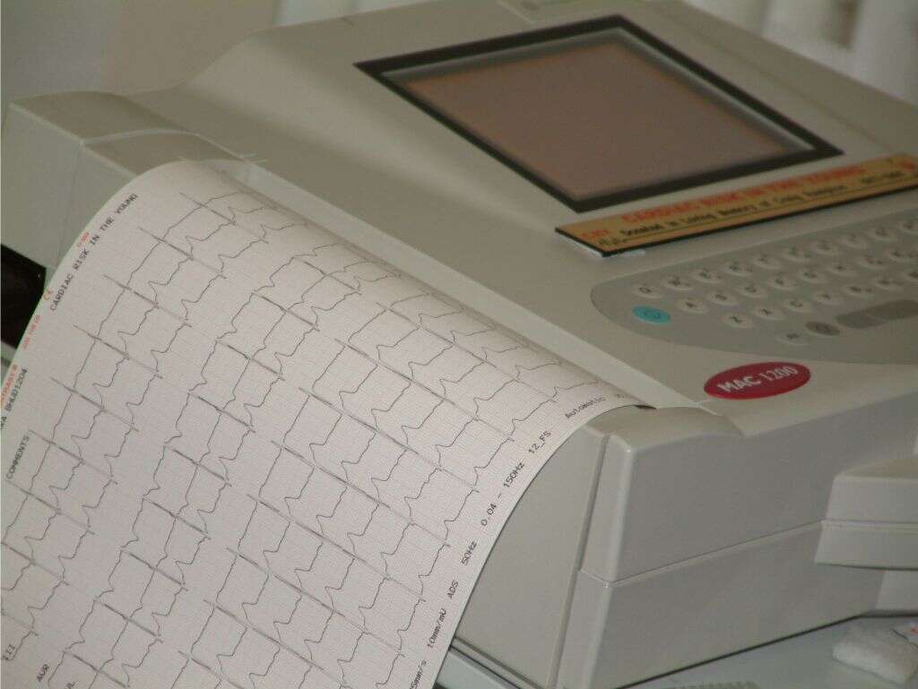 Brugada Syndrome