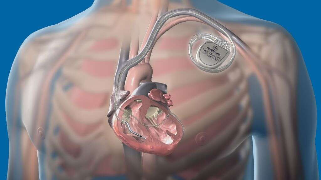Brugada Syndrome