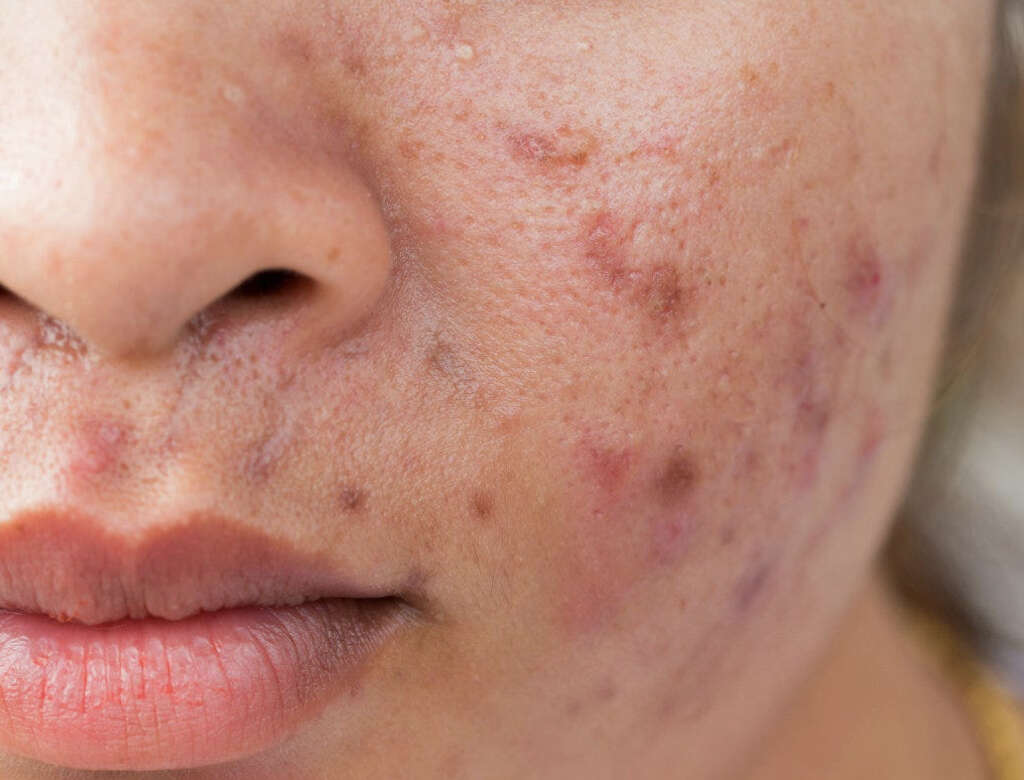 Calcinosis Cutis