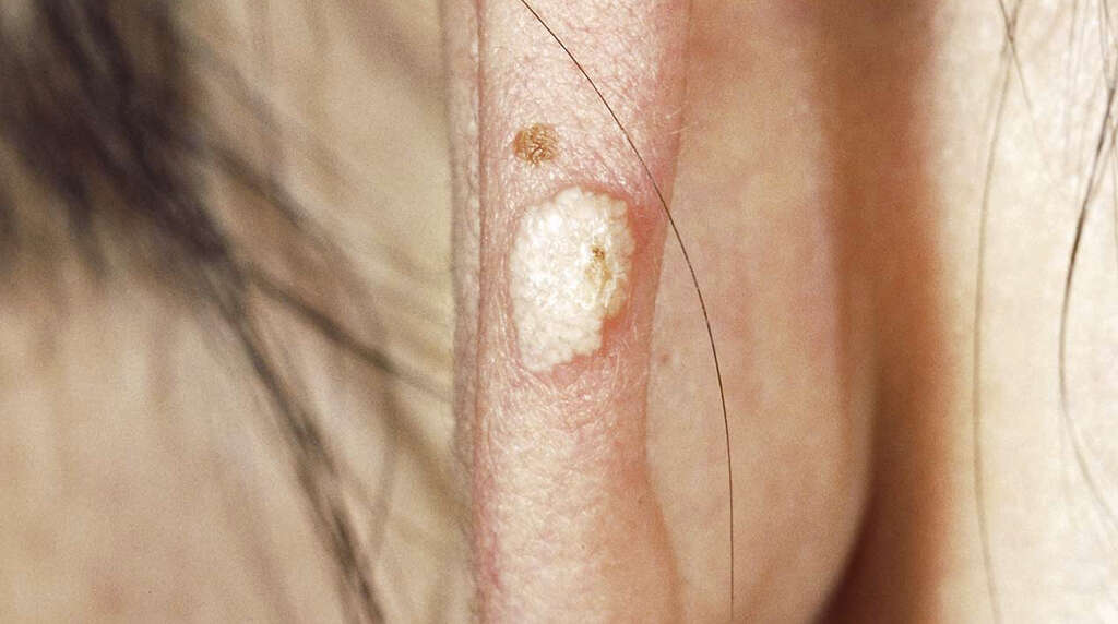 Calcinosis Cutis