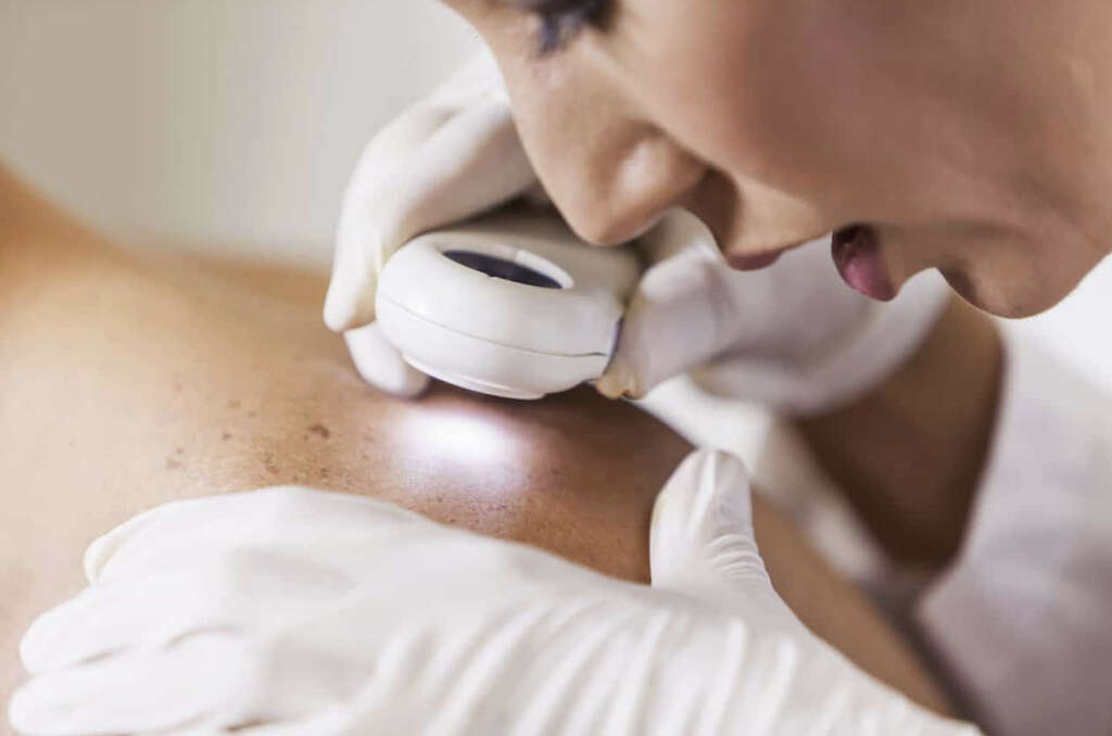 Calciphylaxis