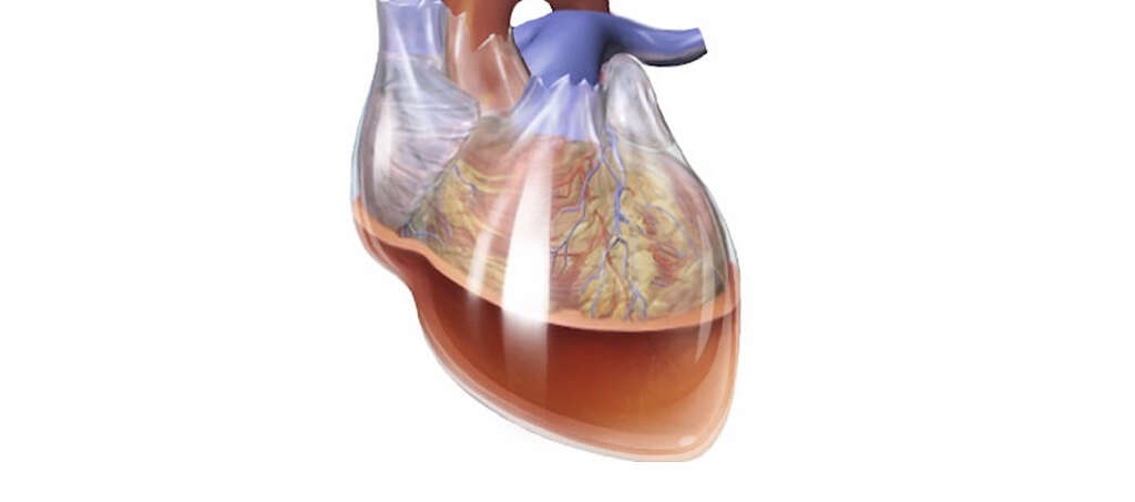 Cardiac Tamponade