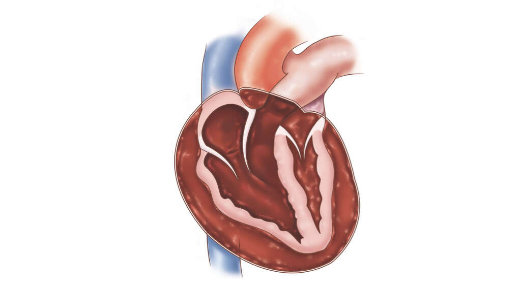 Cardiac Tamponade