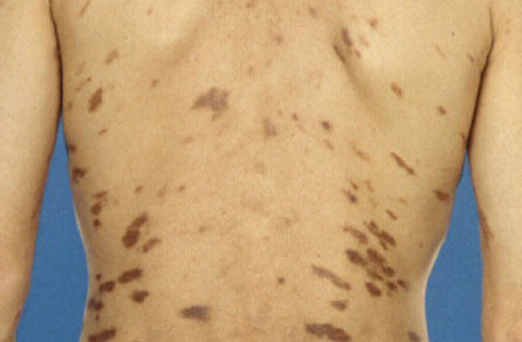 Castleman Disease