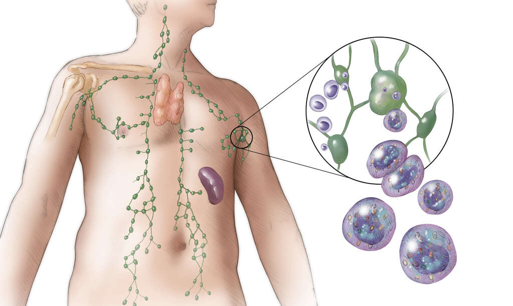 Castleman Disease