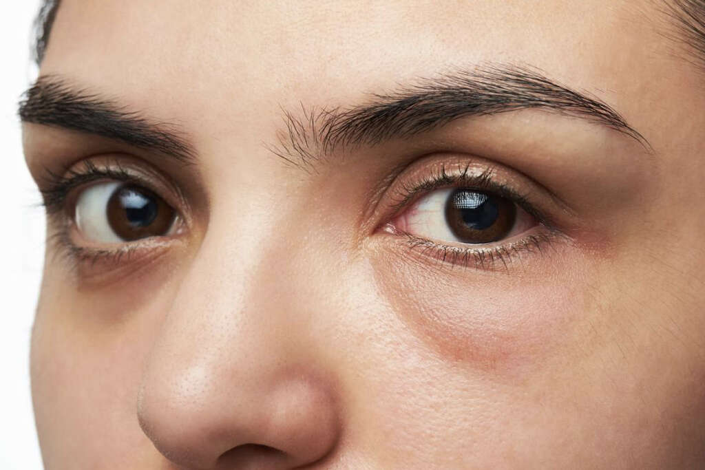 Cavernous Sinus Thrombosis