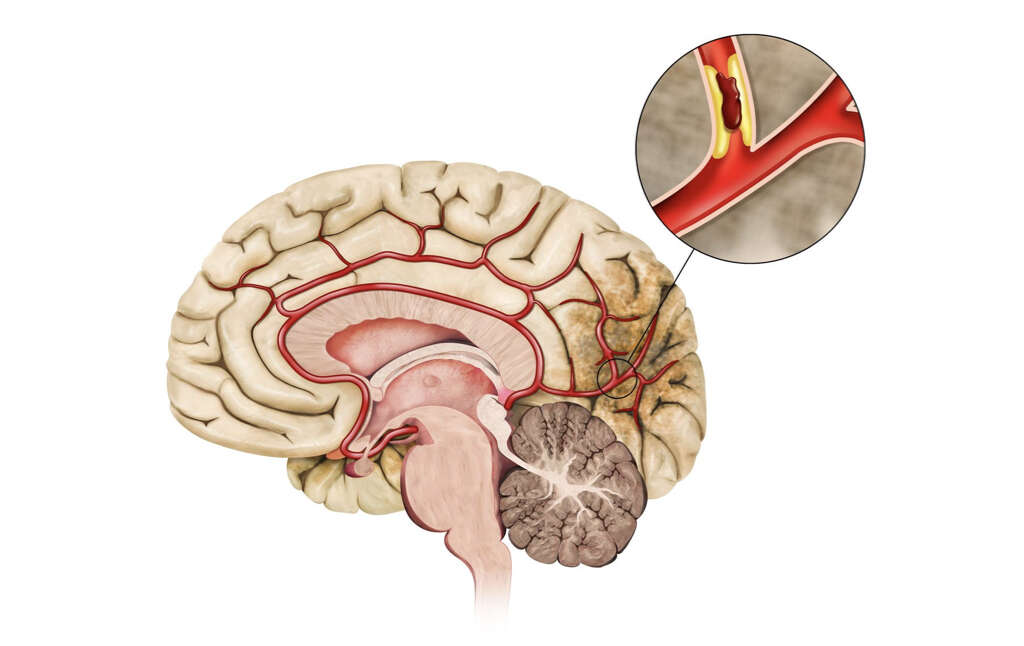 Cerebral Infarction: What Is Cerebral Infarction?