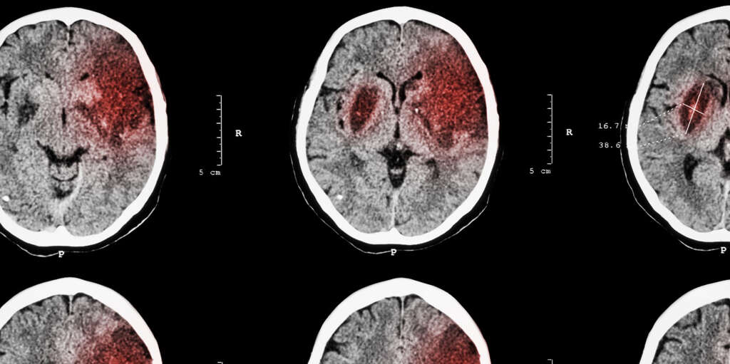 Cerebral Infarction