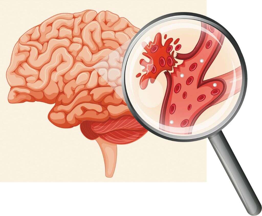 Cerebrovascular Accident