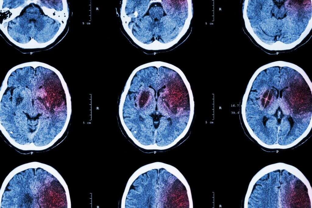 Cerebrovascular Accident