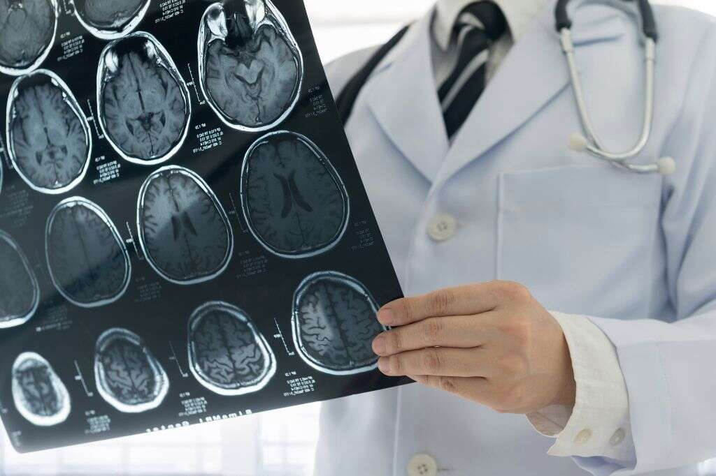 Cerebrovascular Accident