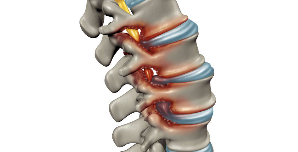 Cervical Stenosis