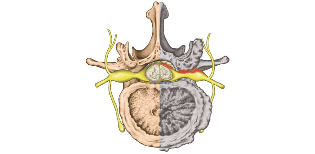 Cervical Stenosis