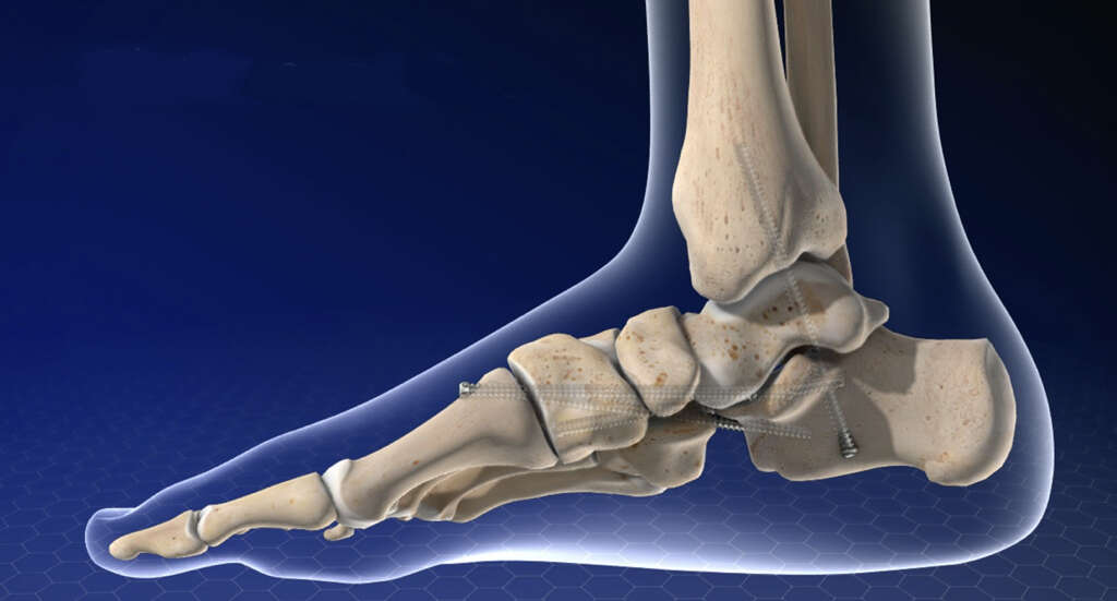 Charcot Foot