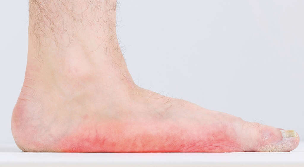 Charcot Foot