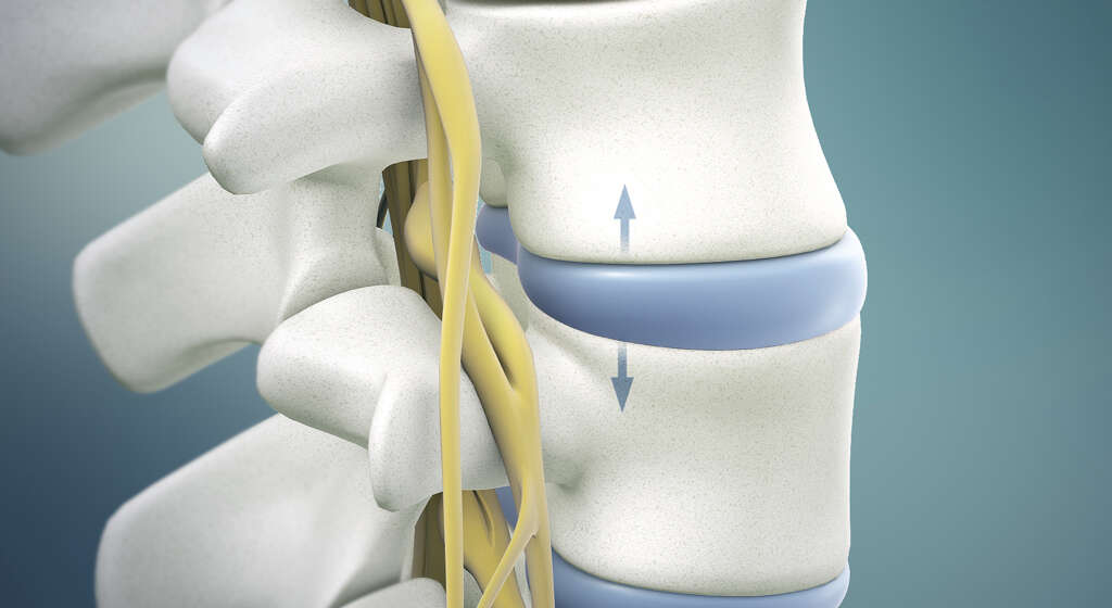 Chiari Malformation