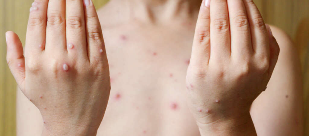 Chicken Pox