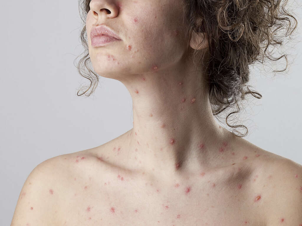 Chicken Pox