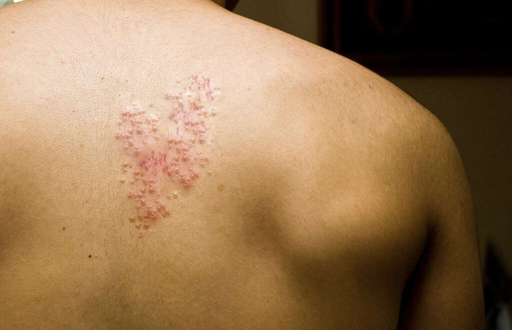Chicken Pox