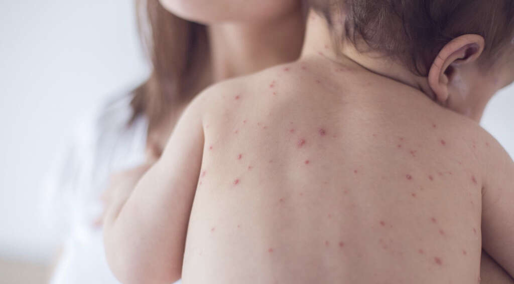 Chicken Pox
