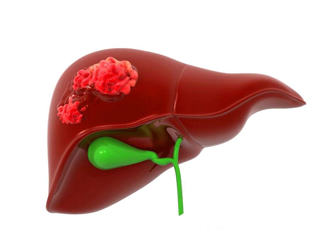 Cholecystitis