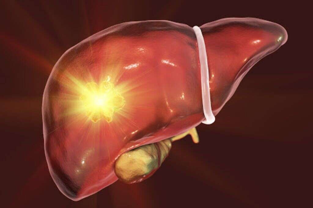 Choledocholithiasis