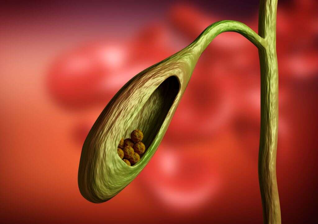 Choledocholithiasis