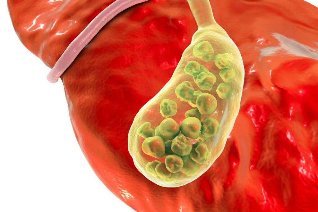 Choledocholithiasis