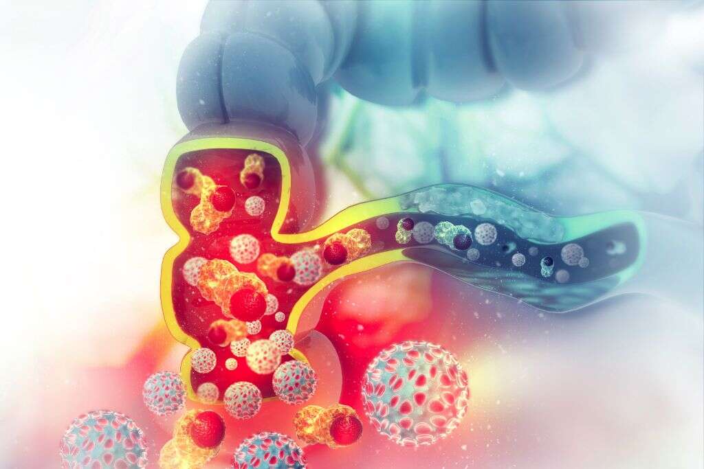 Colon Cancer