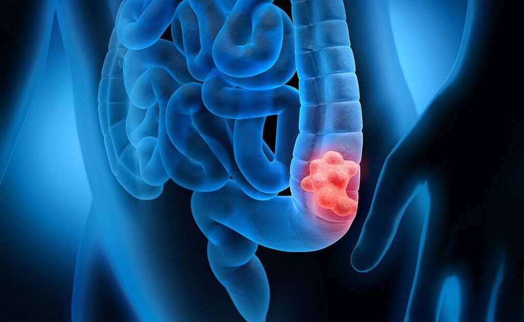 Colon Cancer