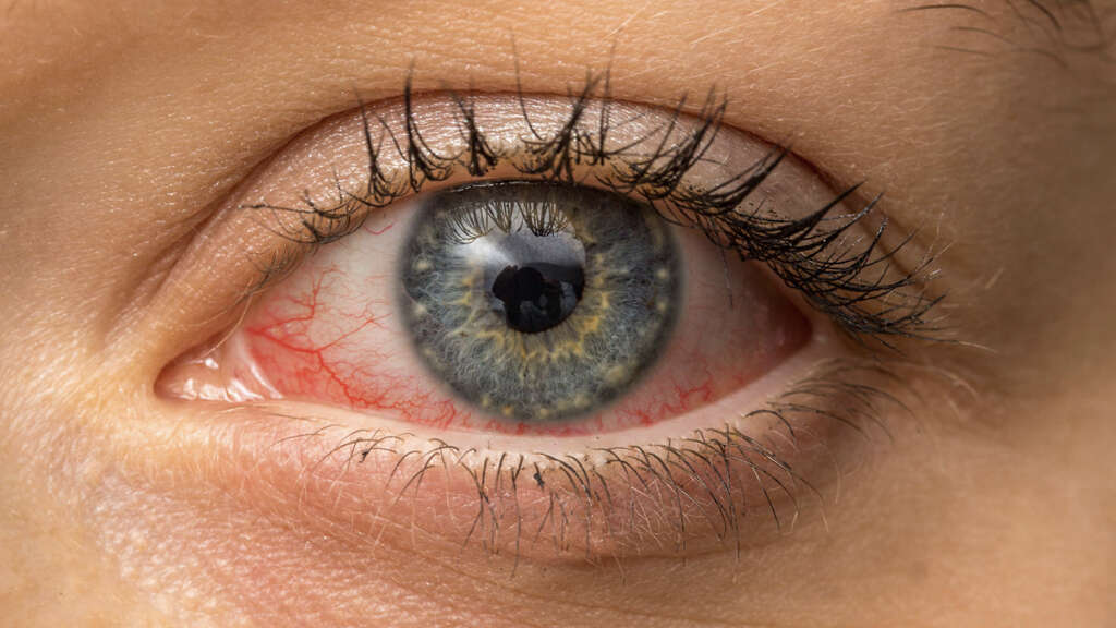 Conjunctivitis