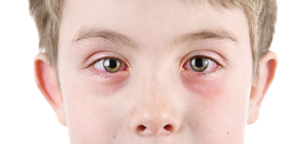 Conjunctivitis