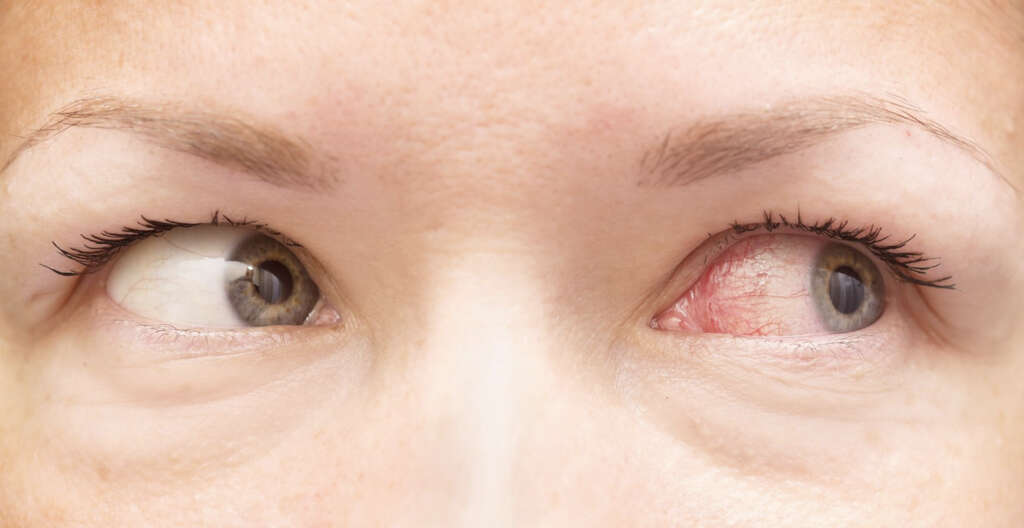 Conjunctivitis