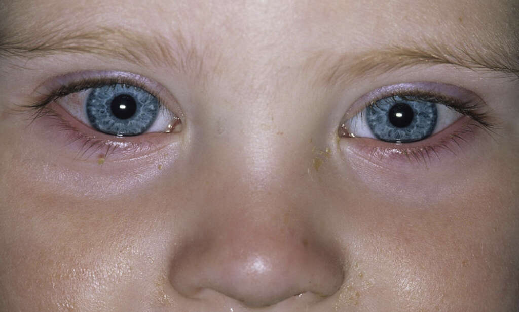 Conjunctivitis