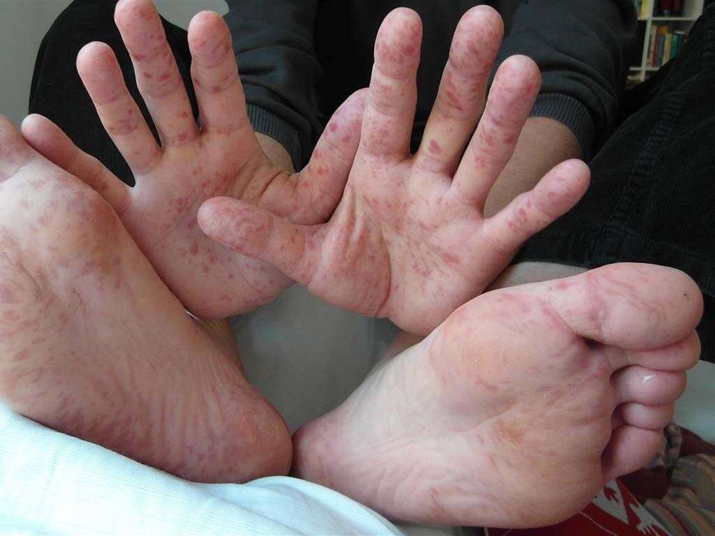 Coxsackievirus