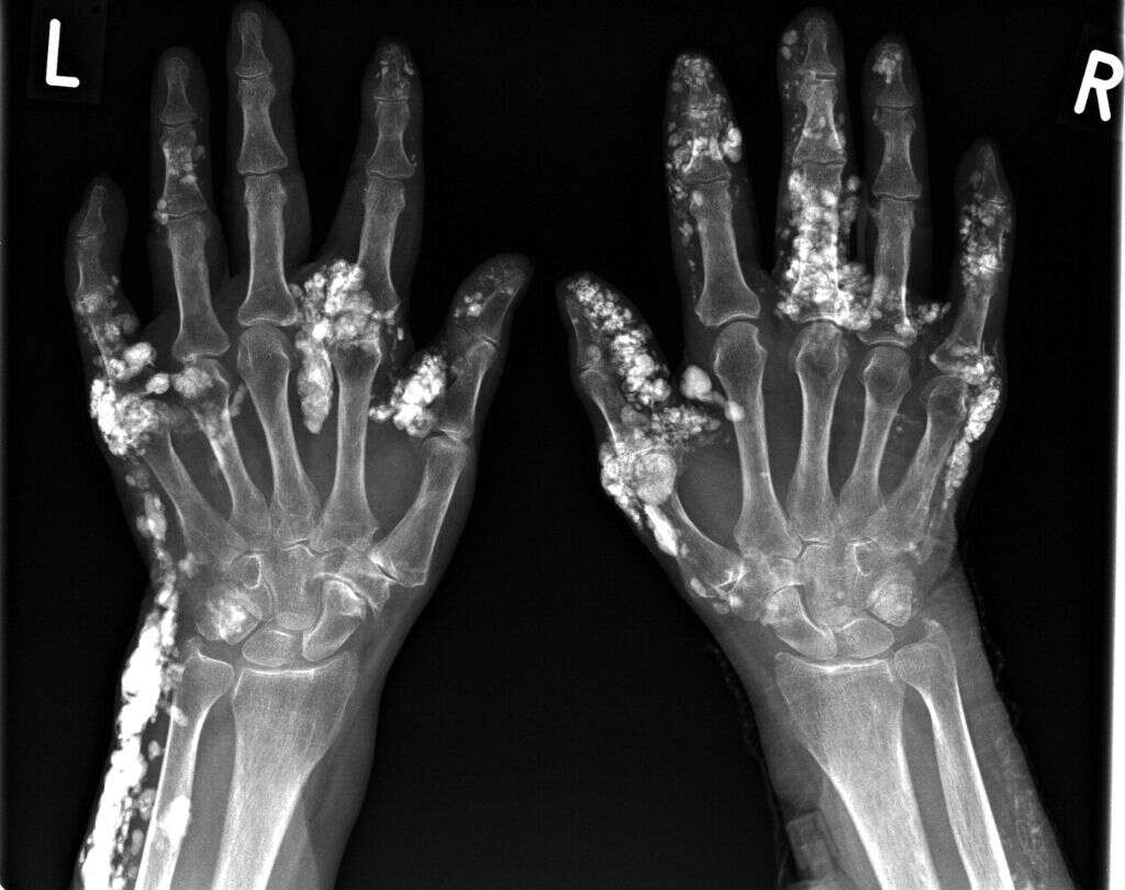 CREST Syndrome