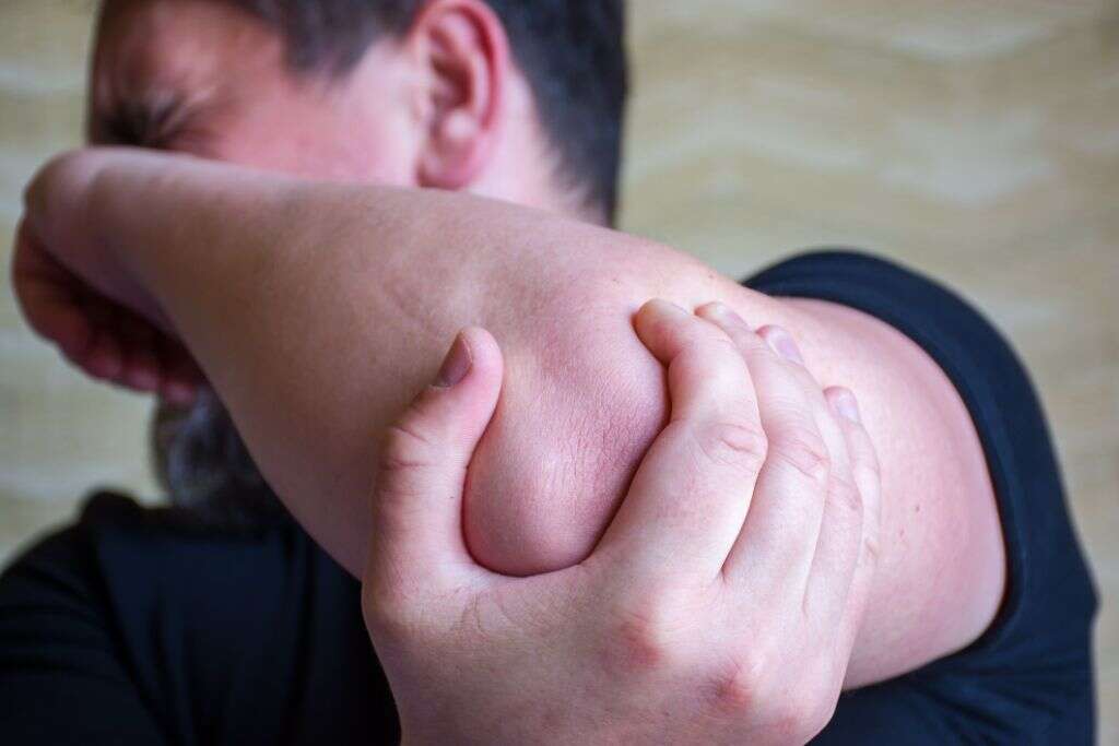 Cubital Tunnel Syndrome