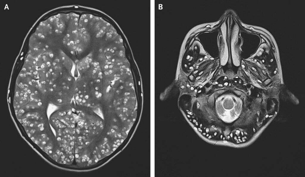 Cysticercosis