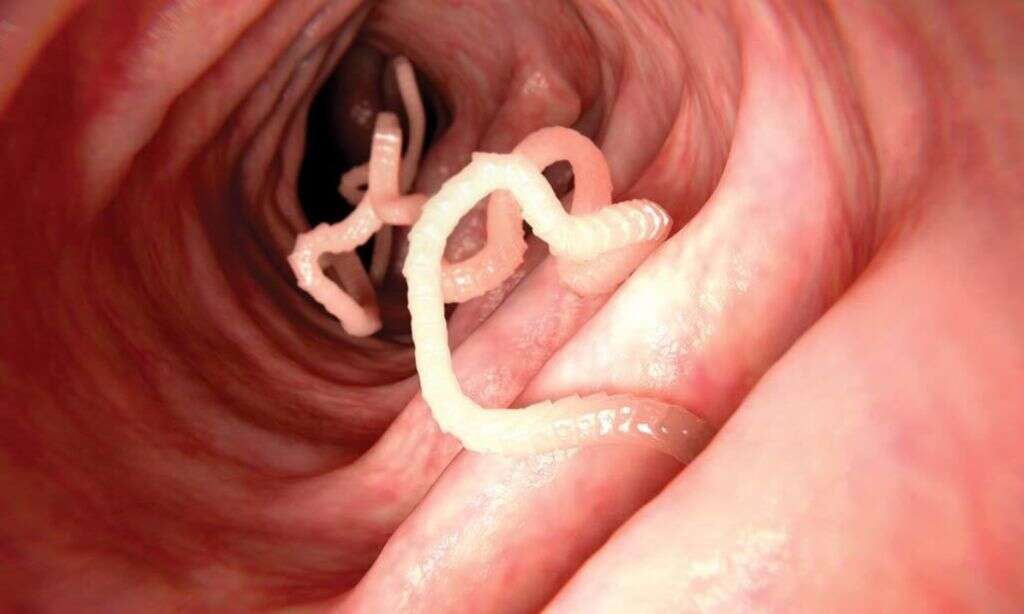Cysticercosis