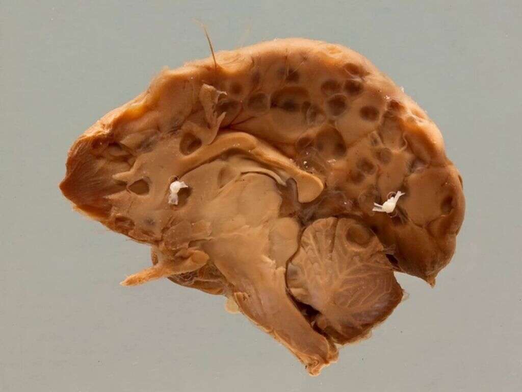 Cysticercosis
