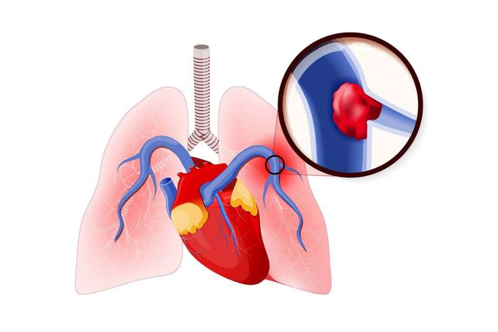 Deep Vein Thrombosis