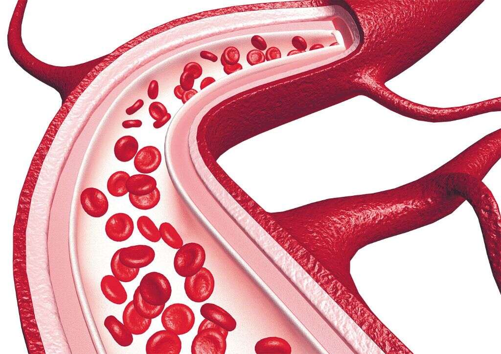 Deep Vein Thrombosis