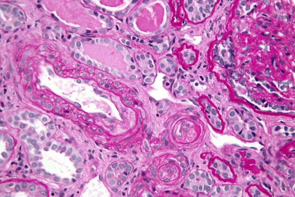 Dermatomyositis