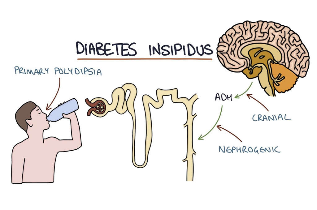 Diabetes Insipidus