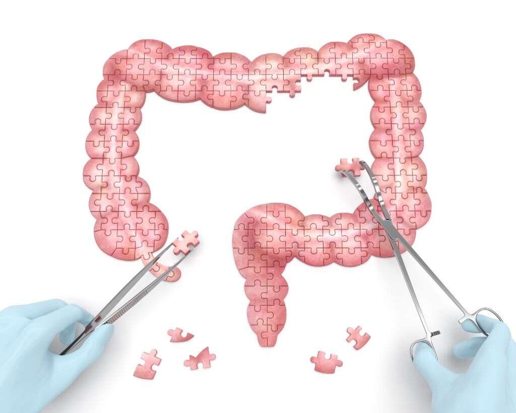 Diverticulitis