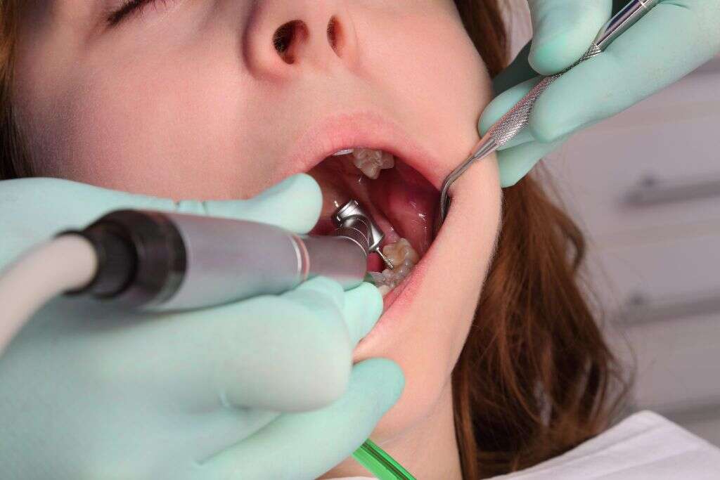 Dry Socket