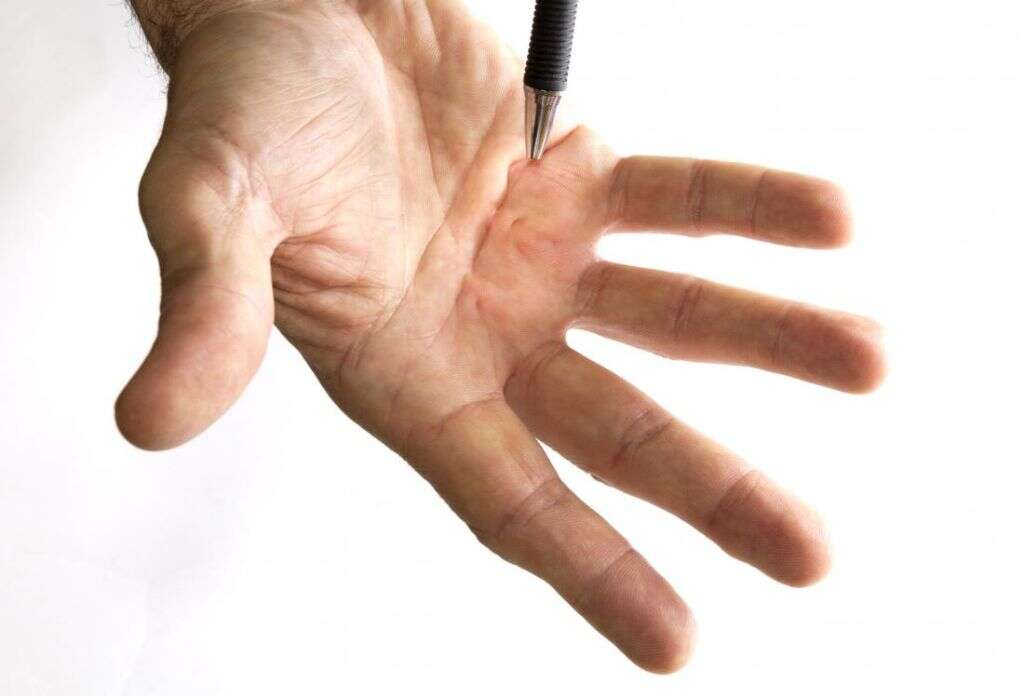 Dupuytren's Contracture