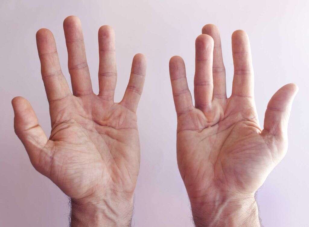 Dupuytren's Contracture