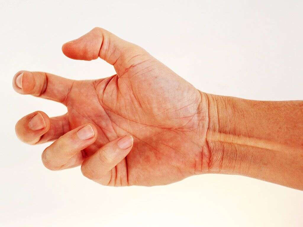 Dystonic Reaction