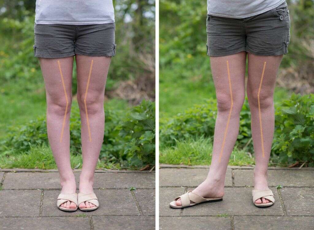 Ehlers Danlos